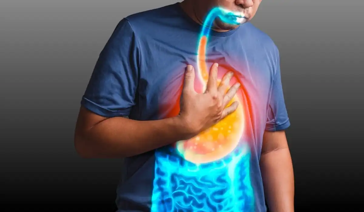 Managing GERD: Beyond Antacids